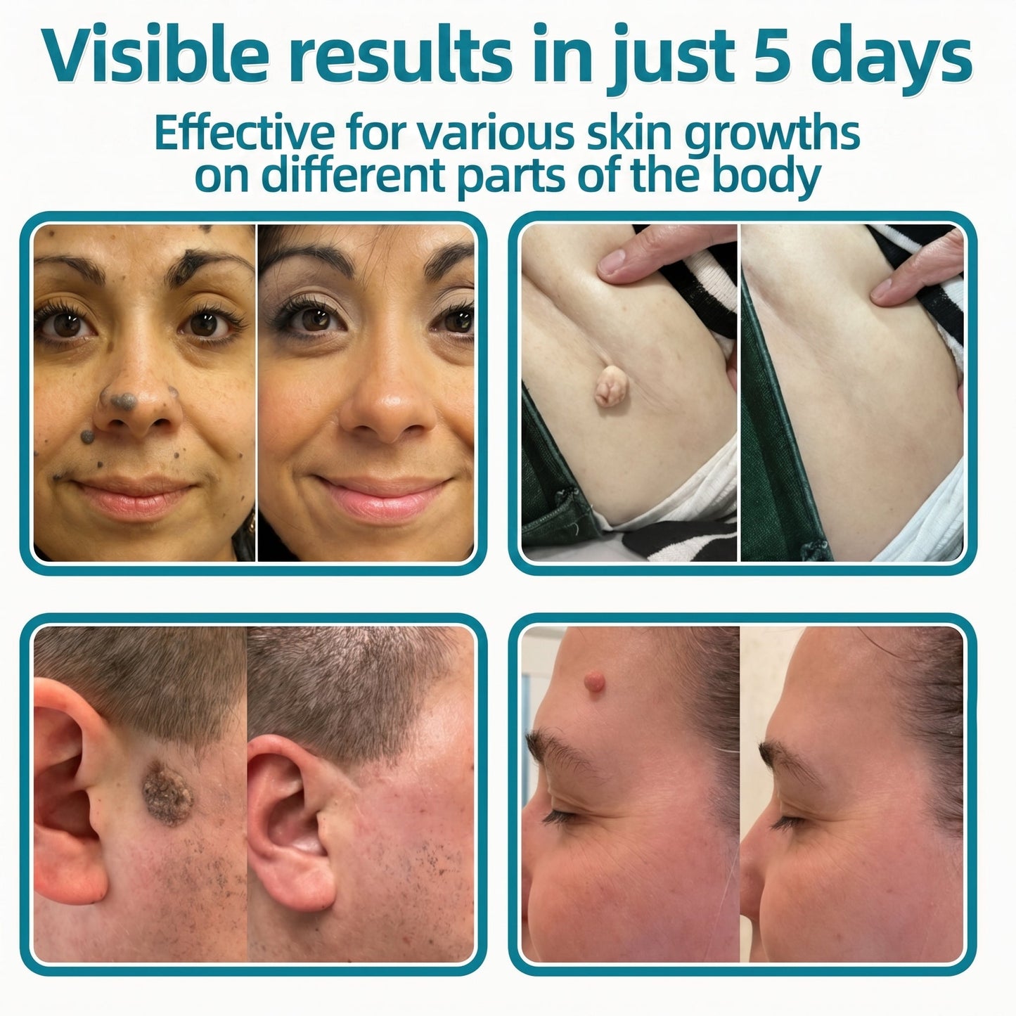 ✅🇦🇺𝐇𝐞𝒂𝒍𝗿𝗶𝙯𝙚®2-in-1 Microneedle & Hydrocolloid Patch🔥| Removes Raised Moles, Acne, Flat Warts & Skin Tags | Helps Improve Wrinkles, Scars & Blemishes | Invisible Patches for Face & Body