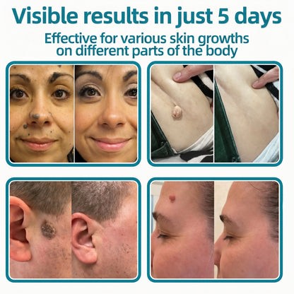 ✅🇦🇺𝐇𝐞𝒂𝒍𝗿𝗶𝙯𝙚®2-in-1 Microneedle & Hydrocolloid Patch🔥| Removes Raised Moles, Acne, Flat Warts & Skin Tags | Helps Improve Wrinkles, Scars & Blemishes | Invisible Patches for Face & Body