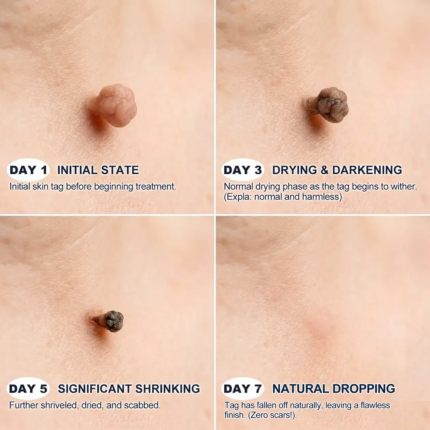 【 🔥Last Day Promotion 70% OFF🔥】🇦🇺𝐇𝐞𝒂𝒍𝗿𝗶𝙯𝙚®2-in-1 Microneedle & Hydrocolloid Patch| Removes Raised Moles, Acne, Flat Warts & Skin Tags | Helps Improve Wrinkles, Scars & Blemishes | Invisible Patches for Face & Body