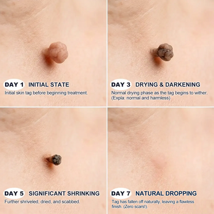【 🔥Last Day Promotion 70% OFF🔥】🇦🇺𝐇𝐞𝒂𝒍𝗿𝗶𝙯𝙚®2-in-1 Microneedle & Hydrocolloid Patch| Removes Raised Moles, Acne, Flat Warts & Skin Tags | Helps Improve Wrinkles, Scars & Blemishes | Invisible Patches for Face & Body