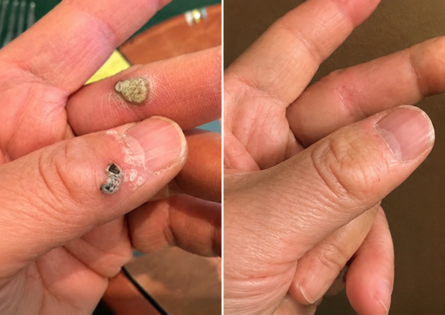 ✅🇦🇺𝐇𝐞𝒂𝒍𝗿𝗶𝙯𝙚®2-in-1 Microneedle & Hydrocolloid Patch🔥| Removes Raised Moles, Acne, Flat Warts & Skin Tags | Helps Improve Wrinkles, Scars & Blemishes | Invisible Patches for Face & Body