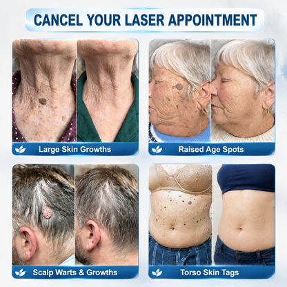【 🔥Last Day Promotion 70% OFF🔥】🇦🇺𝐇𝐞𝒂𝒍𝗿𝗶𝙯𝙚®2-in-1 Microneedle & Hydrocolloid Patch| Removes Raised Moles, Acne, Flat Warts & Skin Tags | Helps Improve Wrinkles, Scars & Blemishes | Invisible Patches for Face & Body
